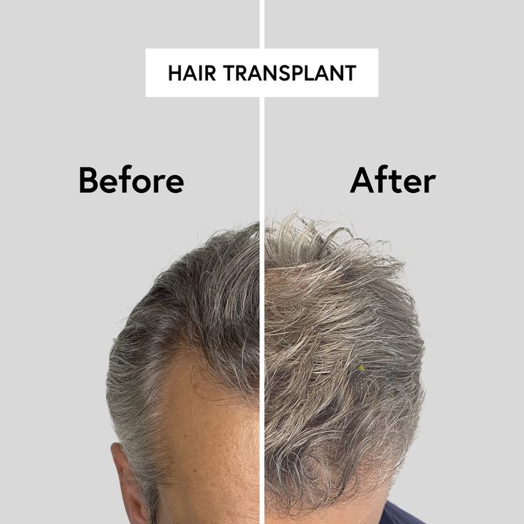 hair transplant i islamabaddd