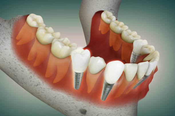 Restore Function and Beauty in Islamabad Dental Implants: