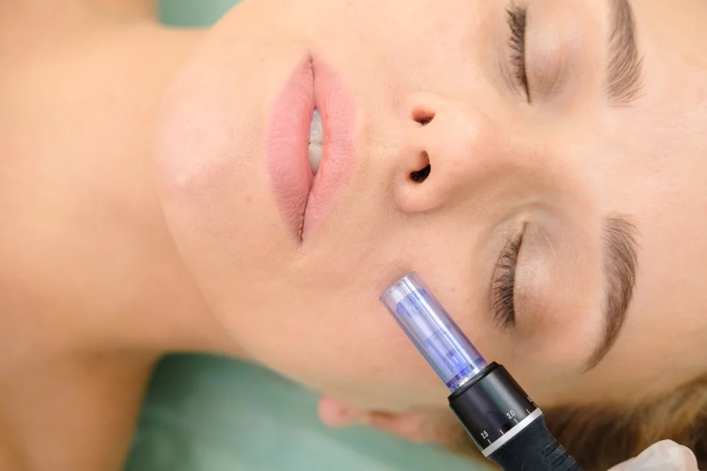 Restore Freshness and Glow through Microneedling in London - Newsglo