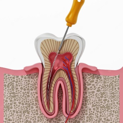 root canal in islamabad
