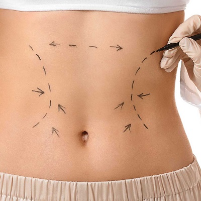 أفضل سن لإجراء عملية شفط الدهون - Newsglo شفط الدهون في مسقط