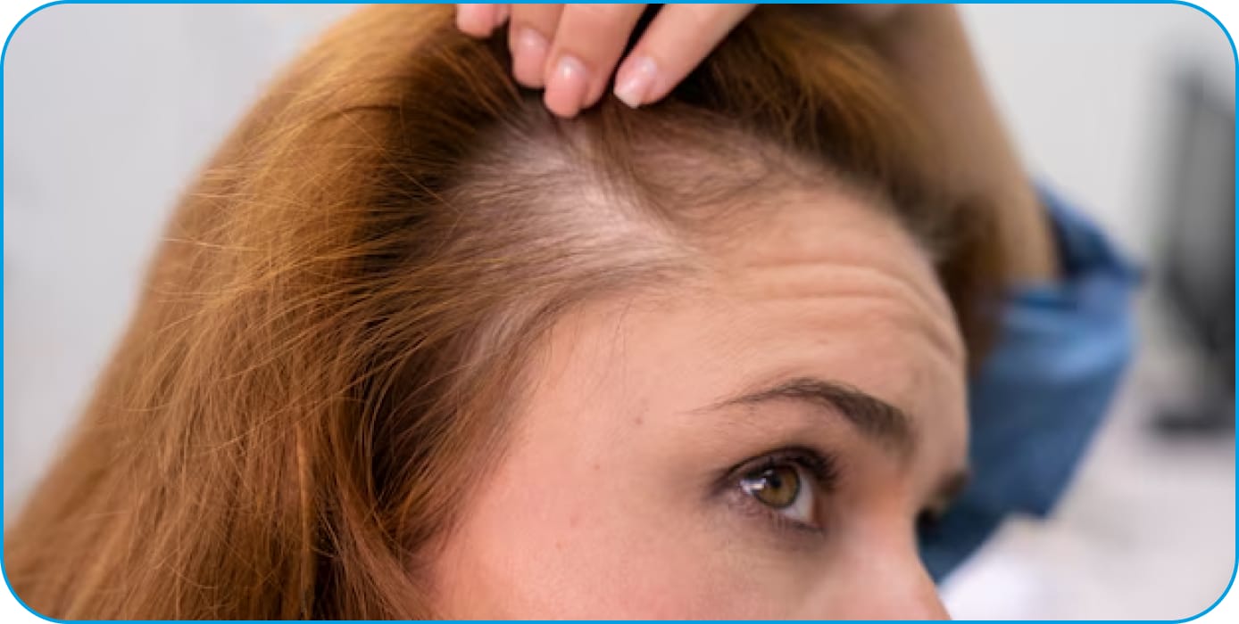 ما هي أسباب تساقط الشعر التي تستدعي زراعة الشعر للنساء؟ - Newsglo