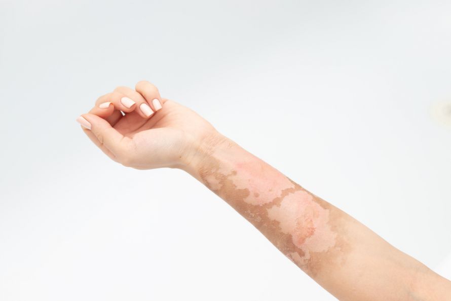 هل تُعيد جراحة ترميم الحروق وظيفة الجلد؟ - Newsglo