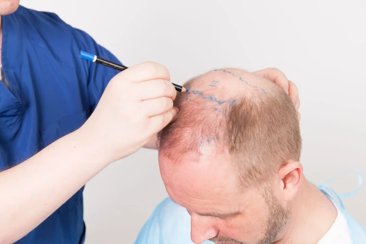 هل زراعة الشعر بتقنية اقتطاف وحدة البصيلات (FUE) مناسبة للشعر الخفيف؟ - Newsglo
