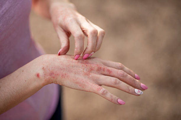 Does Eczema Treatment Prevent Flare-Ups? - Newsglo Does Eczema Treatment Prevent Flare-Ups