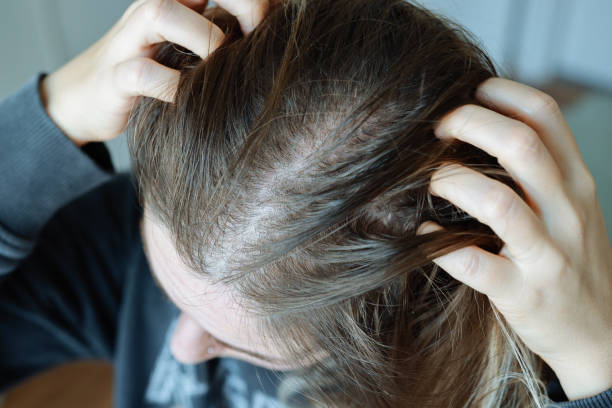 Does Exosomes Hair Treatment Improve Hair Thickness - Newsglo Does Exosomes Hair Treatment Improve Hair Thickness