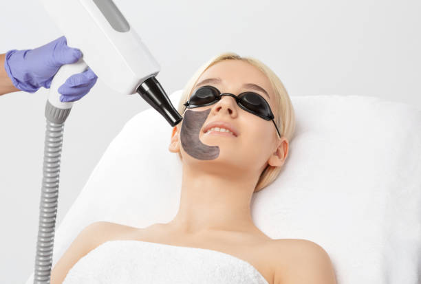 Does Laser Carbon Peel Reduce Pores