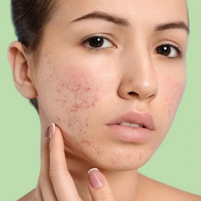 acne scar in islamabad pakistan