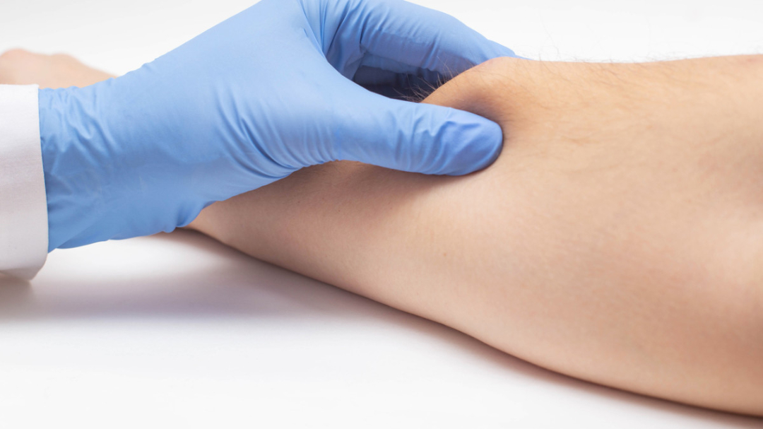 Best Lipoma Treatment in Islamabad – Feel Your Best - Newsglo